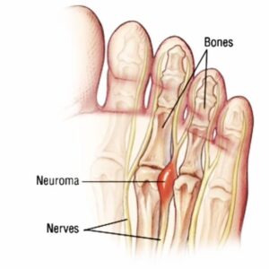 Morton’s neuroma