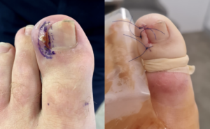 Wedge resection surgery